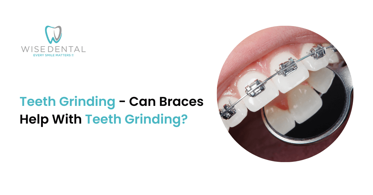 Teeth Grinding – Can Braces Help With Teeth Grinding?