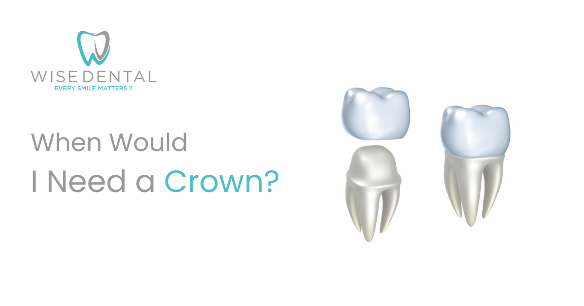 When Would I Need a Crown?