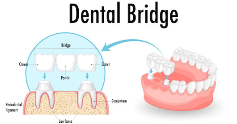 Everything You Need to Know About Dental Bridges: Types, Benefits, and Costs